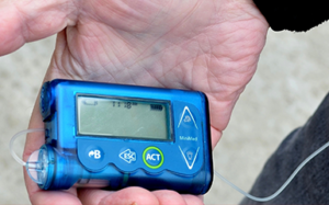 Insulin Pump